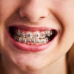 sorriso feminino de aparelho ortodontico
