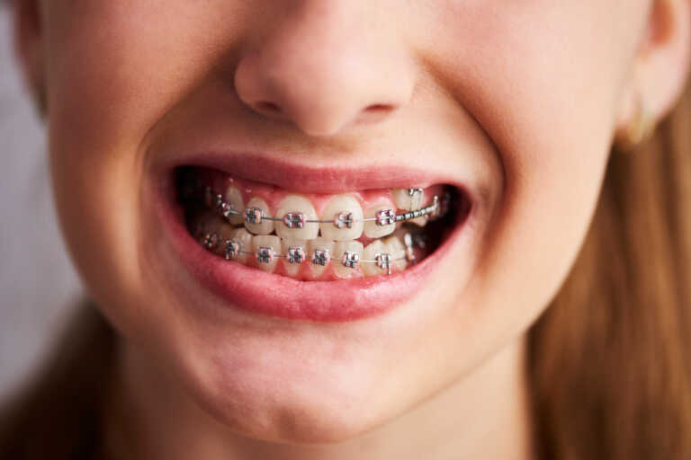 sorriso feminino de aparelho ortodontico