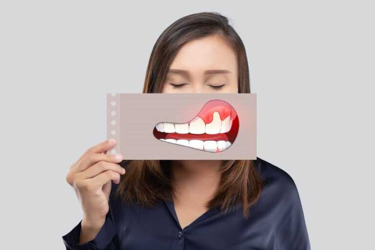 imagem de mulher com card na frente da boca com dentes com periodontite