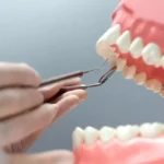 modelo de dentes encavalados