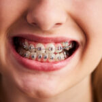 dentes desalinhados tratamento